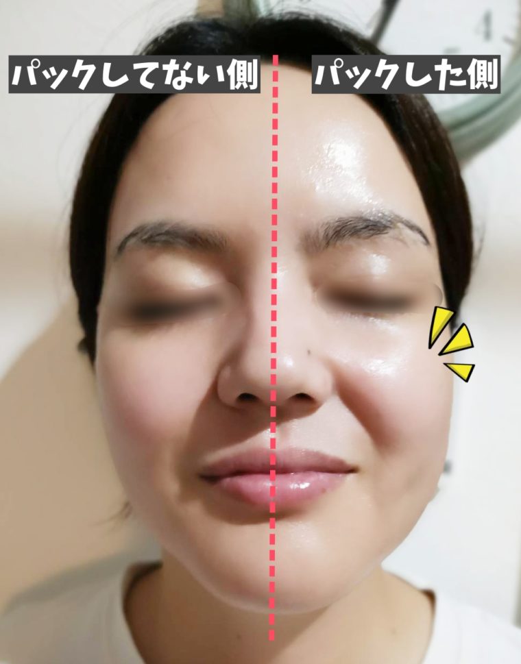 ユンス炭酸パック　ビフォーアフター